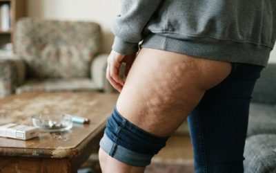 cigarette et cellulite
